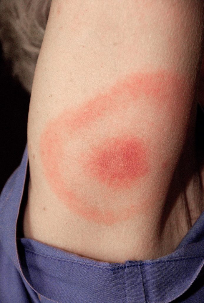 1024px-Erythema_migrans_-_erythematous_rash_in_Lyme_disease_-_PHIL_9875 - LASERMED