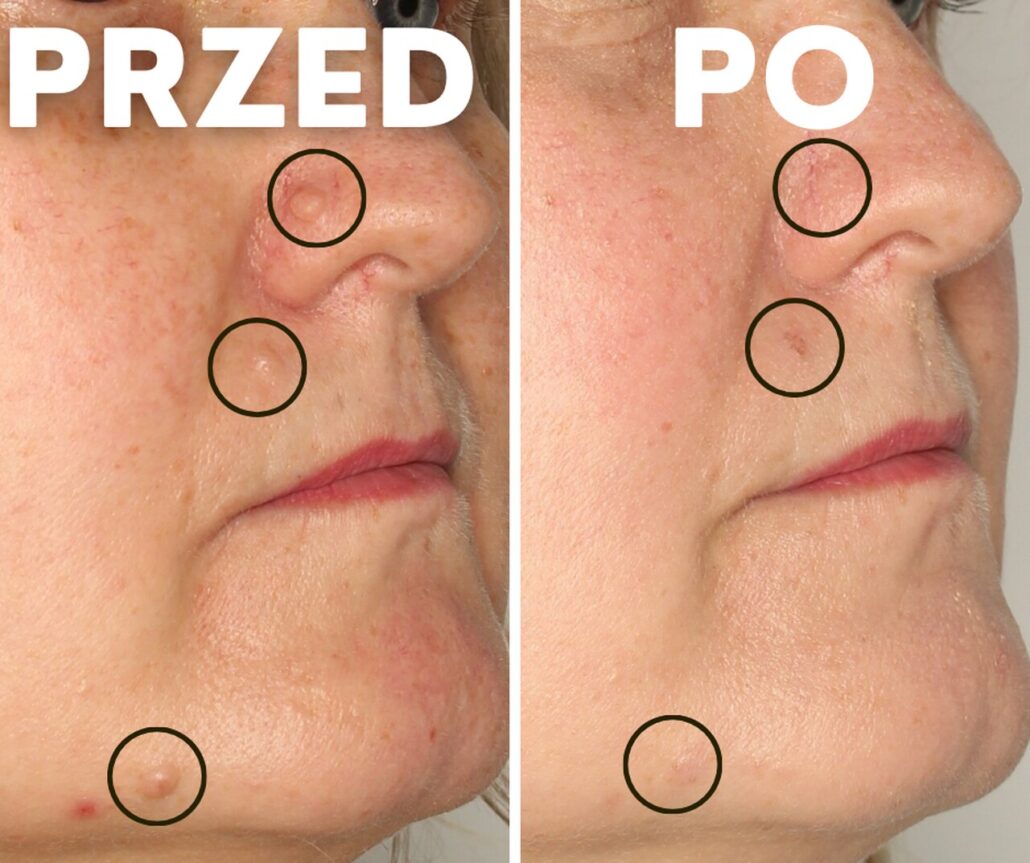 usuwanie zmian skórnych z twarzy